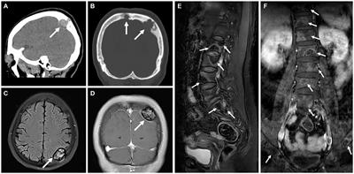 Frontiers Case Report A Rare Case Of Multicentric Angiosarcomas Of